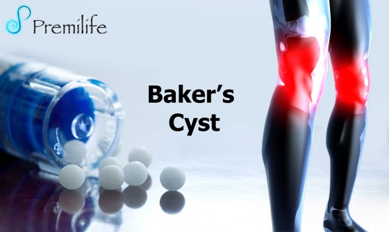 Baker’s Cyst | Premilife - Homeopathic Remedies